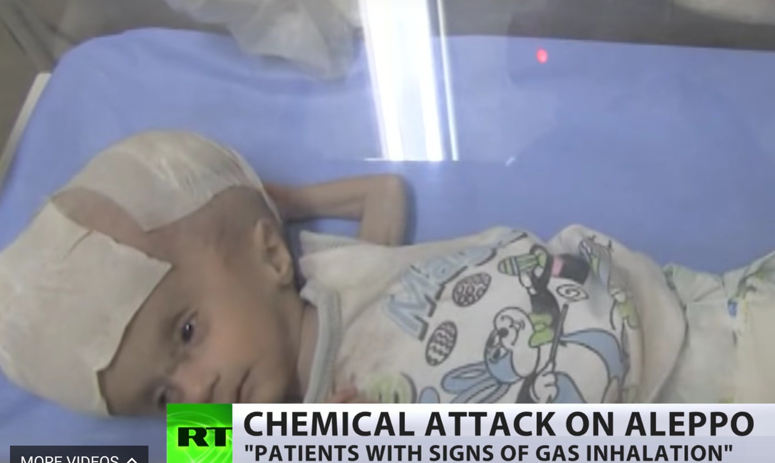 RT’s “gas victim” really a child with untreated hydrocephalus, requiring a shunt. This is a congenital disorder easily treated, more easily diagnosed, but RT’s Tel Aviv staff are displaying the child as a chemical attack victim of Assad.